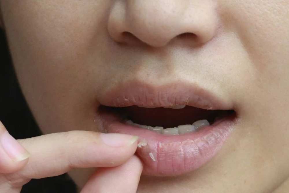 Kenali 5 Penyebab Bibir Kering dan Gelap yang Perlu Diwaspadai!